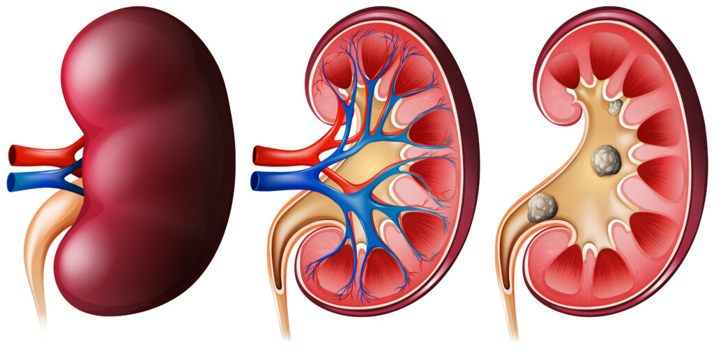 Acute Renal Failure